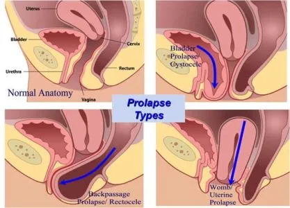 Diagram comparing normal pelvic anatomy to three types of pelvic organ prolapse: bladder prolapse (cystocele), where the bladder drops toward the vaginal opening; back passage prolapse (rectocele), where the rectum bulges into the vagina; and womb (uterine) prolapse, where the uterus descends into the vagina.