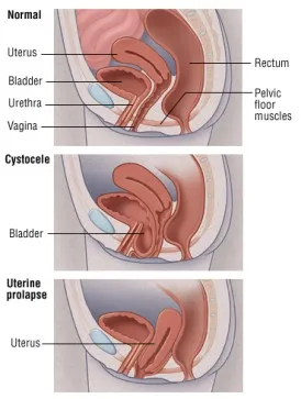 Cross-section diagrams comparing normal pelvic anatomy (uterus, bladder, urethra, vagina, rectum, pelvic floor muscles) to a cystocele (bladder dropping into the vagina) and uterine prolapse (uterus descending into the vagina).